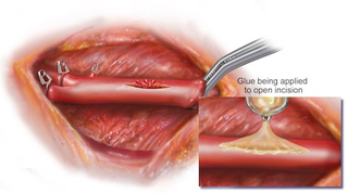Illustration for article titled This worm-inspired glue can mend broken hearts